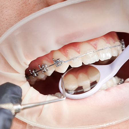 Self-Ligating Braces