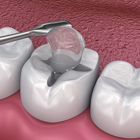 Dental Sealants