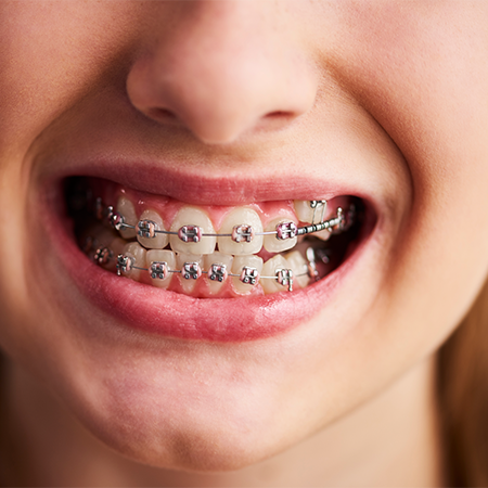 Metal Braces